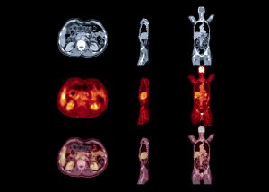 PET Scan image of whole body Comparison Axial , Coronal and Sagittal plane. medical technology concept.